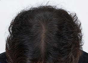 줄기세포 두피주사 시술 후 두피