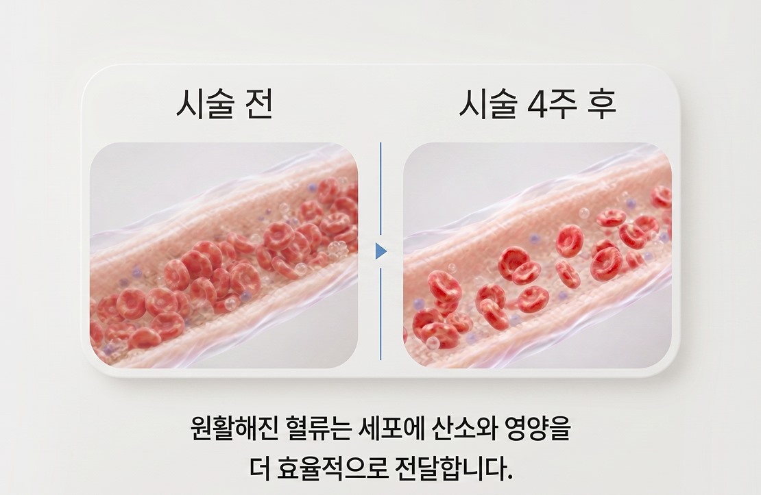시술 전과 시술 4주 후의 혈류 비교 — 원활해진 혈류가 세포에 산소와 영양을 전달