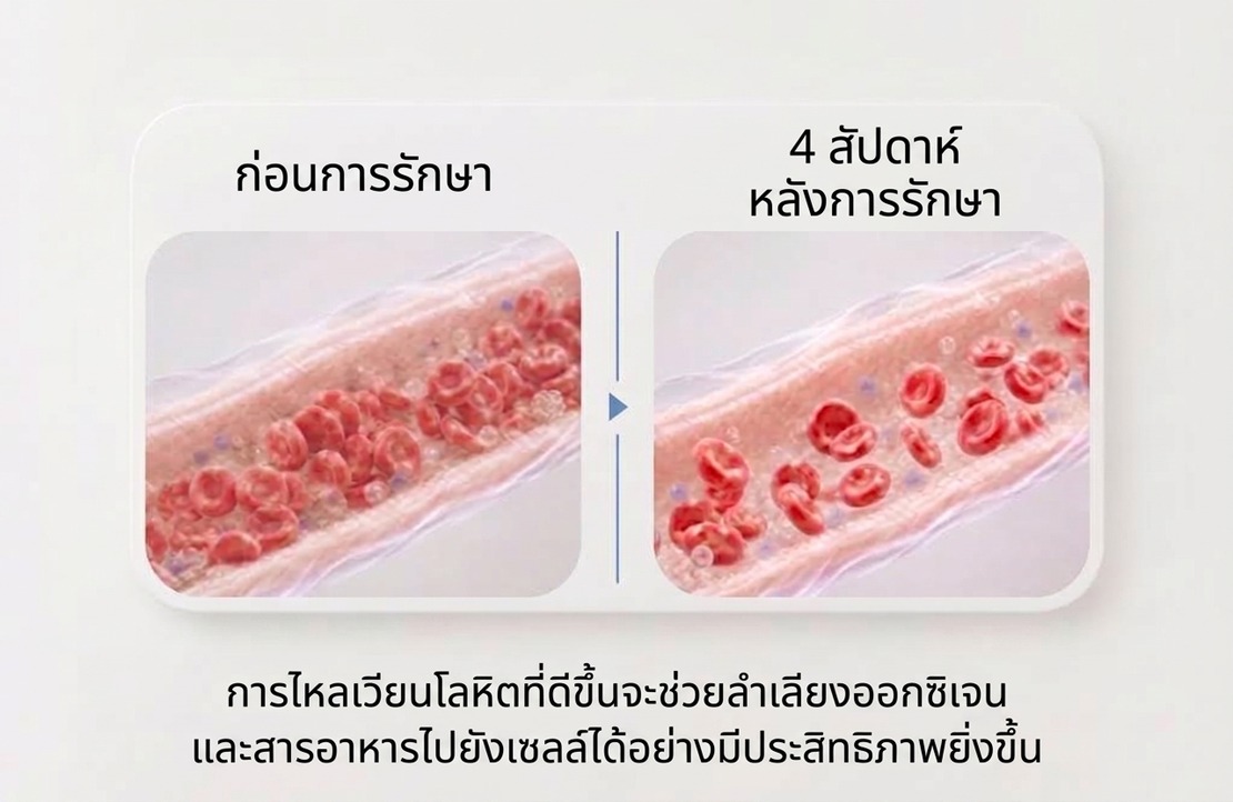 เปรียบเทียบการไหลเวียนเลือดก่อนทำหัตถการและ 4 สัปดาห์หลังทำ — เลือดที่ไหลเวียนดีขึ้นช่วยนำออกซิเจนและสารอาหารไปสู่เซลล์
