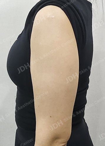온다리프팅 시술 전