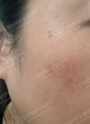 리팟레이저 시술 후