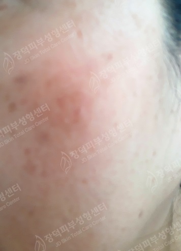 리팟레이저 시술 후