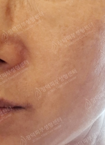 리팟레이저 시술 후