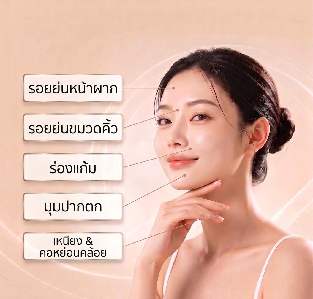 บริเวณใบหน้าที่เกิดความหย่อนคล้อย — ริ้วรอยหน้าผาก ริ้วรอยหว่างคิ้ว ร่องแก้ม มุมปากตก เหนียงและคอหย่อนคล้อย