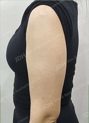 온다리프팅 시술 전
