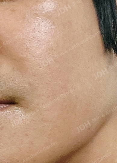 CO2 점 제거 시술 후 피부