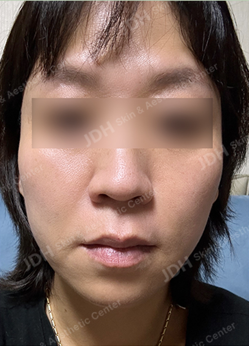 리프팅 시술 후