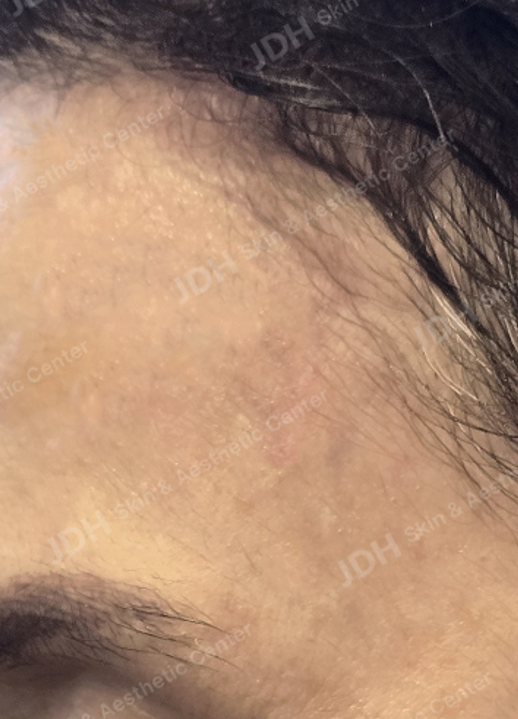리팟레이저 시술 후