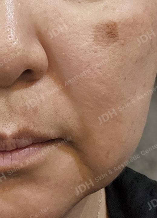 리팟레이저 시술 전