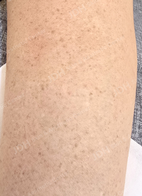 리팟레이저 시술 후