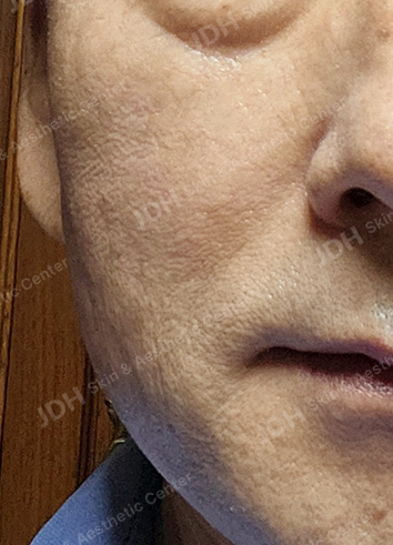 리팟레이저 시술 후