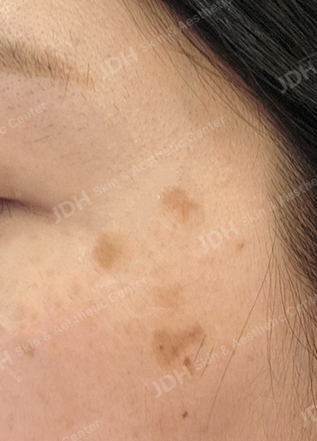 리팟레이저 시술 전