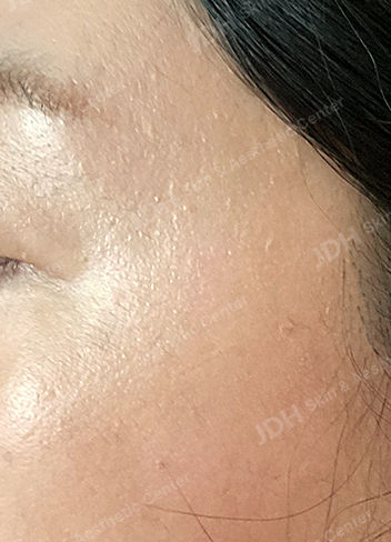 리팟레이저 시술 후