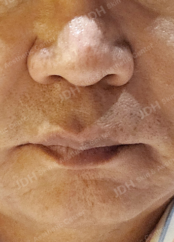 쥬브젠 시술 후 피부