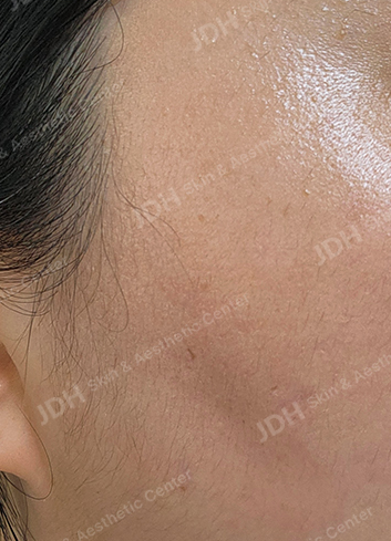 리팟레이저 시술 후