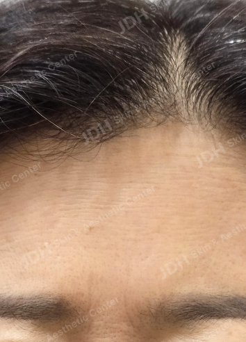 쥬브젠 시술 후 피부