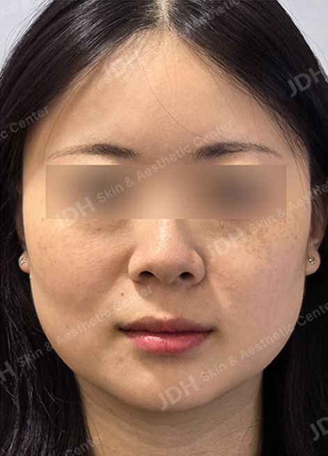 보톡스 시술 전