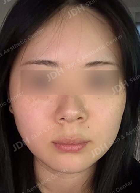 보톡스 시술 후