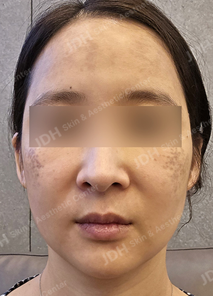 실리프팅 시술 전