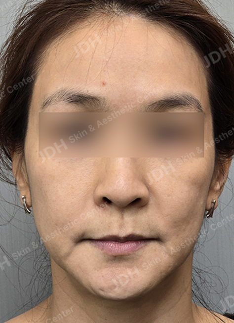 피부 줄기세포 시술 전