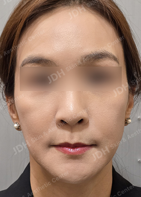 피부 줄기세포 시술 후