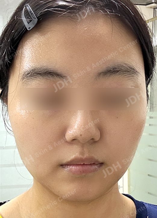 슈링크 시술 후