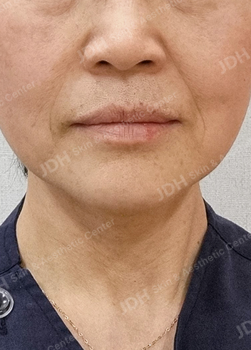올리지오 시술 전