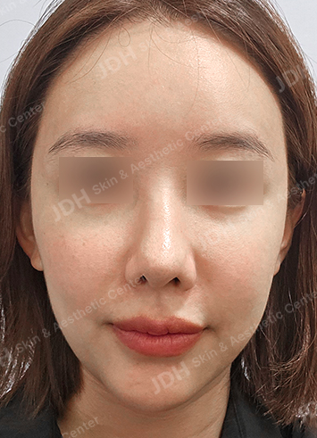 피부 줄기세포 시술 전