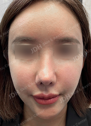 피부 줄기세포 시술 후