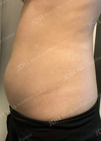 JD 지방분해주사 시술 전