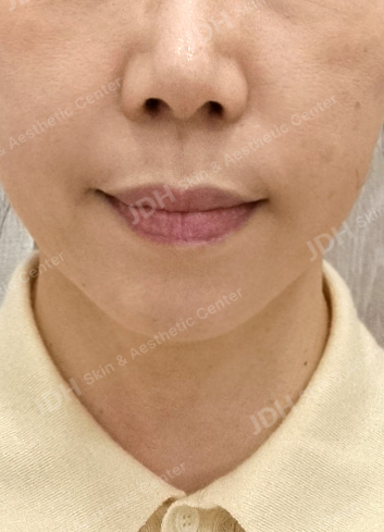 레비나스 시술 후 얼굴 윤곽
