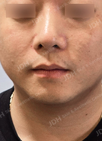미주안 시술 전