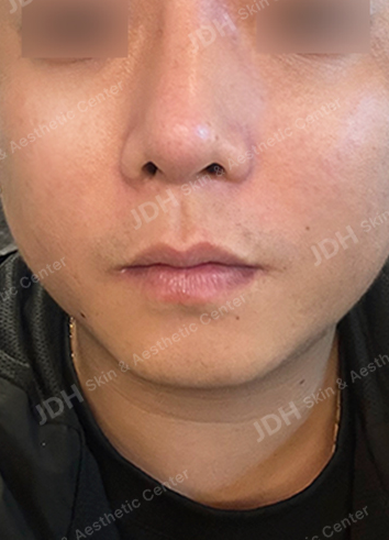 미주안 시술 후