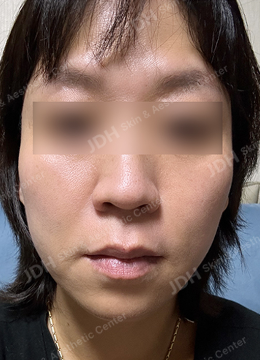 提升 施术后