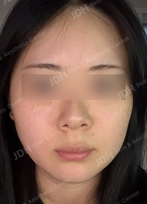 肉毒素 施术后