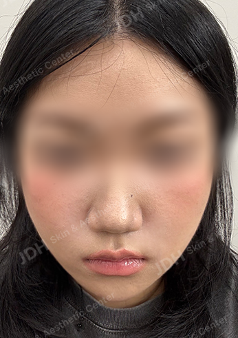 施术后 INMODE